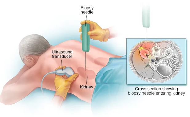 Kidney_Biopsy-S_N_Hsopital