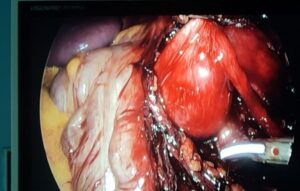 Laparoscopic_Pyeloplasty