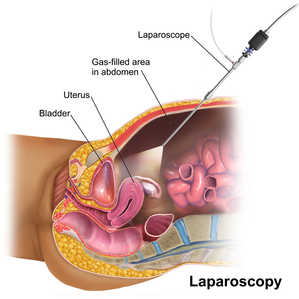 Laparoscopy at SN Hospital