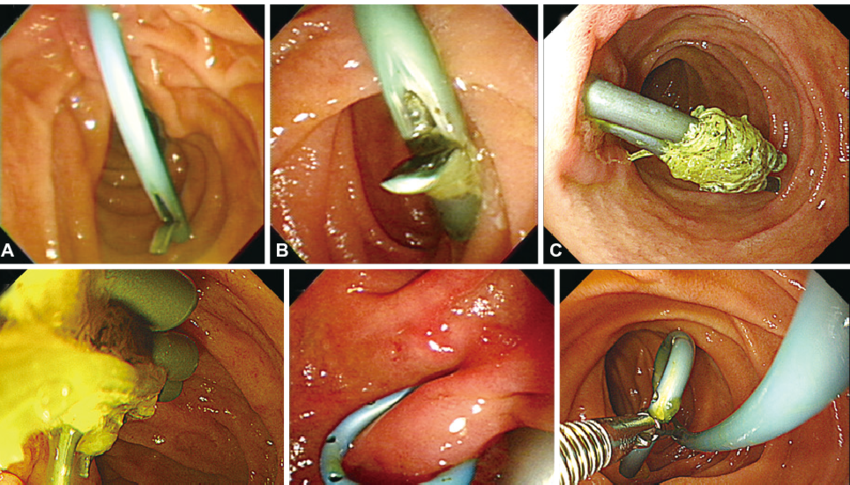 Biliary-stenting-SNHospital